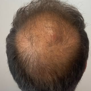 🌟Perdere i capelli? L’alopecia androgenetica (AGA) potrebbe essere la ragione per cui si perdono ca