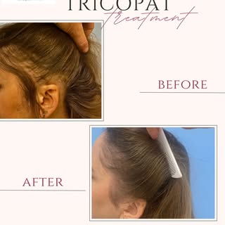 💫Caso clinico di una paziente di 48 anni che presenta alopecia da trazione con diradamenti sulla zo