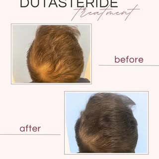 La dutasteride è un trattamento innovativo per contrastare la caduta dei capelli causata dall’alopec