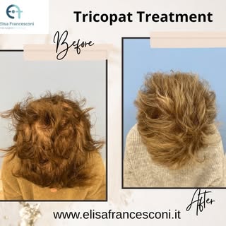 💫Caso clinico di una paziente di 52 anni che presenta ipotrochia diffusa post menopausa con diradam