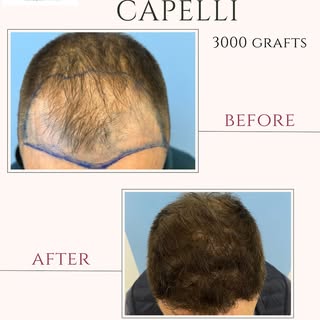 Trapianto di Capelli con tecnica FUE , 3000 unitá follicolari impiantante nella zona frontale , risu