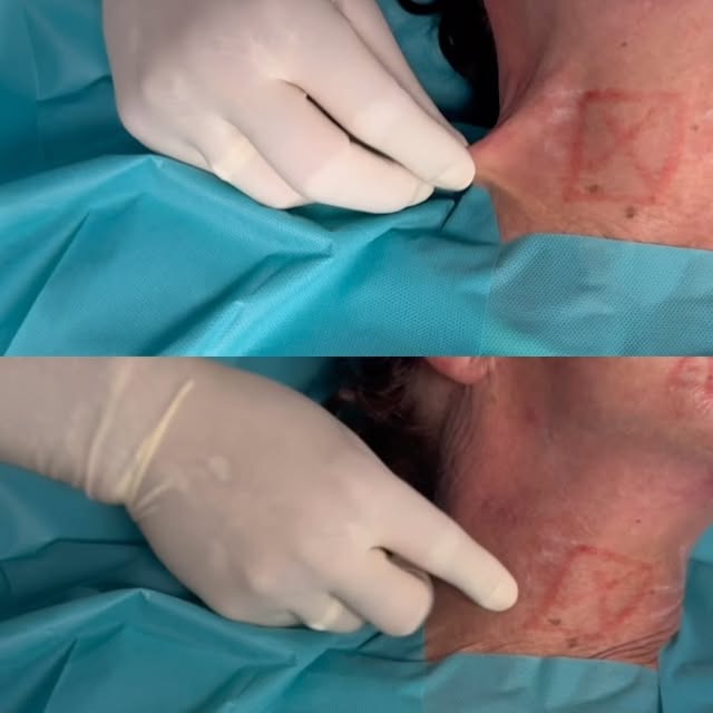 #endolift #endoliftingláser #drsaityilmaz #medecineesthetique #luxembourgcity