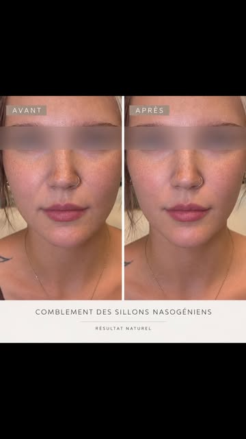 Combler les sillons nasogéniens tout en conservant un résultat naturel et harmonieux.

L’objectif n’