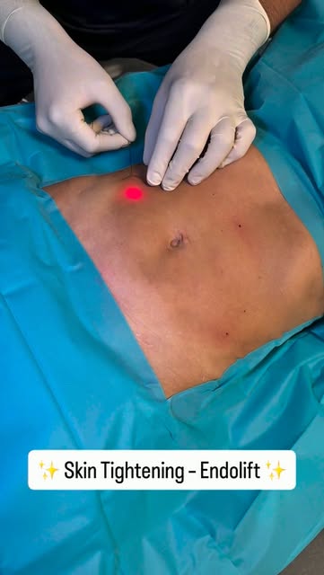 #endolift #endolaser #medecineesthetique #drsaityilmaz #luxembourg