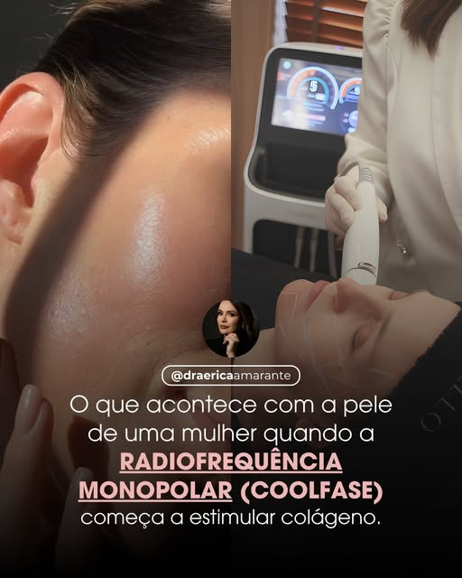 A radiofrequência monopolar (COOLFASE, WOLNEWMER) , tratamento que a Carolina Dieckmann fez recentem