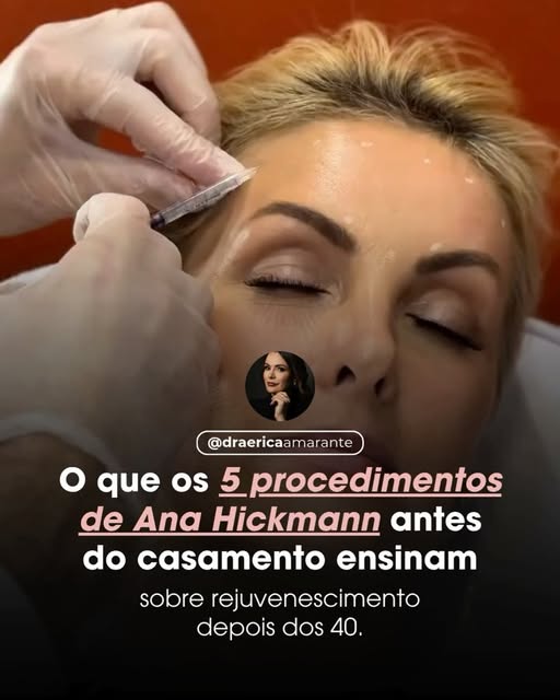 Ana Hickmann se preparou durante meses para o casamento e escolheu combinar diferentes tratamentos. 