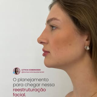 A transição entre lábios, queixo e mandíbula devolvendo a estrutura que o rosto pedia.

A falta de d