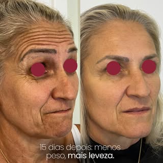 Muitas pessoas acreditam que a toxina botulínica serve apenas para suavizar rugas. Mas, na prática, 