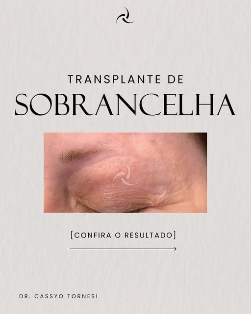 Você sabia que originalmente o transplante de sobrancelhas era destinado a vítimas de queimaduras? 
