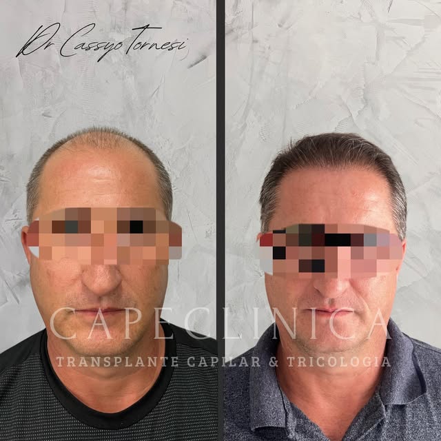 ✅ Transformação Incrível em 12 meses!
 
A precisão e a arte do transplante capilar pode ser vista ne