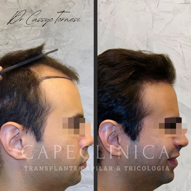 ✔️ Evolução transplante capilar FUE

💡 Se você deseja soluções personalizadas para a calvície, não 