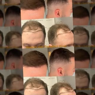🔥 6 Months Post Hair Transplant Results 🔥

From a receded hairline to a natural, fuller look in ju