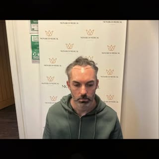 ✨ 6 Months Post DHI Hair Transplant — Amazing Results!

Just 6 months into the journey and the trans