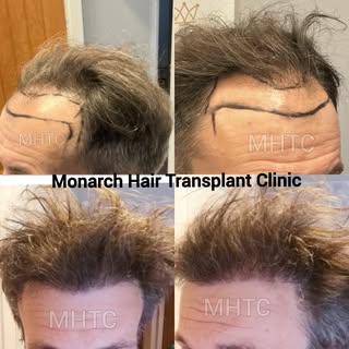 6 Months After an Unshaven FUE Hair Transplant 🔥

A fantastic transformation so far following hairl