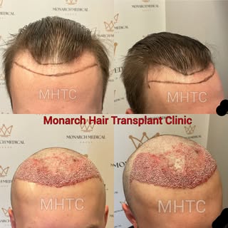 Fresh out of surgery.

A one-day FUE hair transplant focused on restoring and refining the hairline,