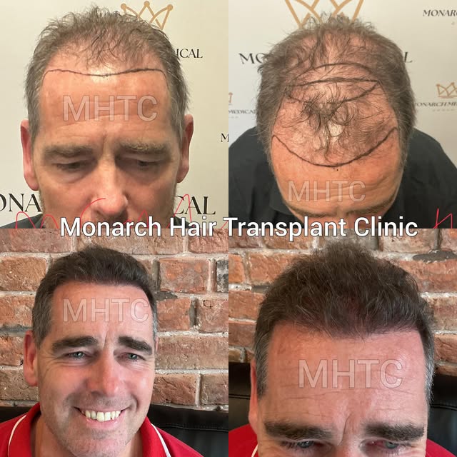 6 Months. Amazing Progress. 🔥

Amazing results at just 6 months — redefining the hairline and addin
