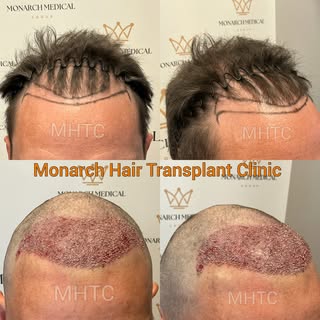 Immediate Post-Op Results ✨

A subtle adjustment can make a big difference.

For this patient, the a