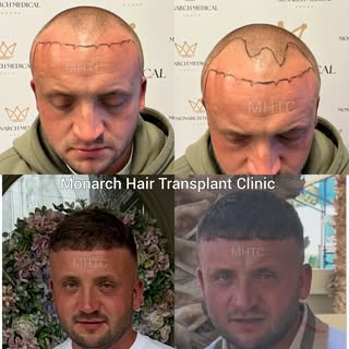 🔥 HAIRLINE TRANSFORMATION 🔥

From a significantly receded hairline to a stronger, fuller and more 