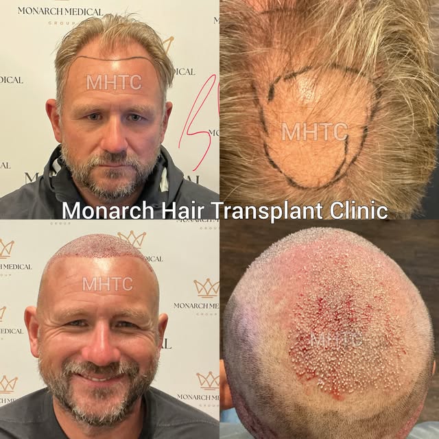 Immediate Post-Operative | Two-Day FUE Hair Transplant

A comprehensive two-day FUE procedure design