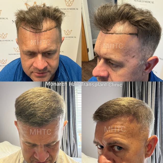 ✨ 6 MONTH RESULTS

A fantastic transformation at just 6 months post-op.

For this patient, we focuse