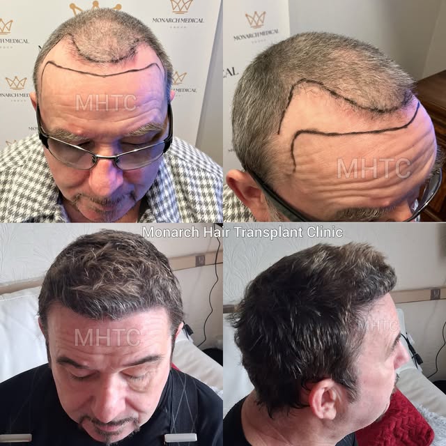 Just 6 months post hair transplant 🔥

An impressive early transformation — and this result is still
