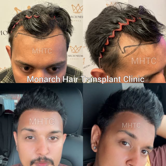 6 MONTHS POST-OP | HAIRLINE TRANSFORMATION 👑

A fantastic 6-month result at Monarch Hair Transplant