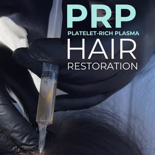 PRP (Platelet-Rich Plasma) treatment is a non-surgical procedure used for hair restoration. 💉 

It 