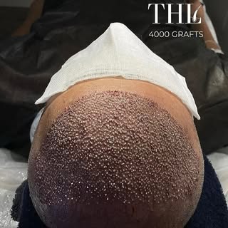 💎 Witness another triumphant hair transplant surgery! Our patient received an astonishing 4000 graf