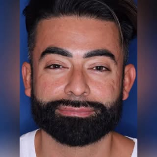 “Good hair genetics”… or a carefully planned hair restoration?

This 39 year old patient is shown on