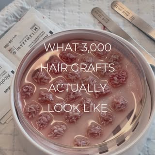 A NeoGraft FUE hair transplant is much more than simply moving hair from one area to another. Every 