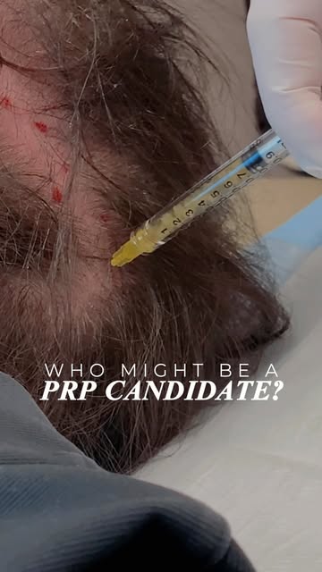 Not every type of hair loss needs a transplant, and not every patient experiencing thinning is autom