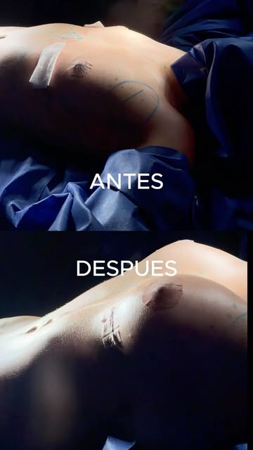 Una de las preguntas que más recibo en consulta es: ¿qué cirugía de busto necesito? 💛

Y la respues