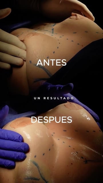 Una de las preocupaciones más comunes que escucho en consulta es: “Doctor, ¿y si me quedan muy grand