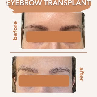Brows can completely change the way a face looks. But for many people, thinning eyebrows happen over