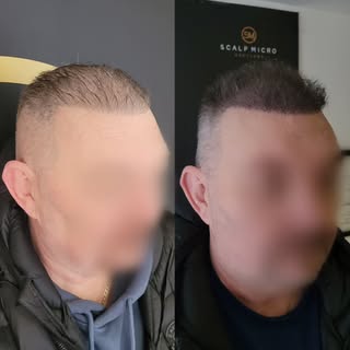 Hair density treatment after 3 sessions of Scalp Micropigmentation 🙌

Complimentary consultations a