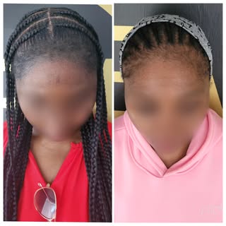 Hairline strengthened for our Female client ☺️

Complimentary consultations available (in-clinic or 