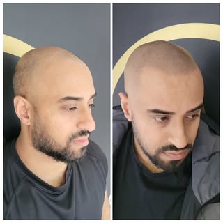 Amazing SMP transformation for Majid 🙌

After shot taken post treatment. Redness will subside in a 