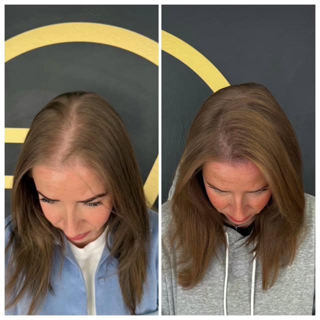 Hair density treatment 🖊🙌❤️

Complimentary consultations available (in-clinic or online)

📩 scalp