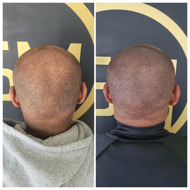 Horseshoe no more 🙌

Complimentary consultations available (in-clinic or online)

📩 scalpmicroscot