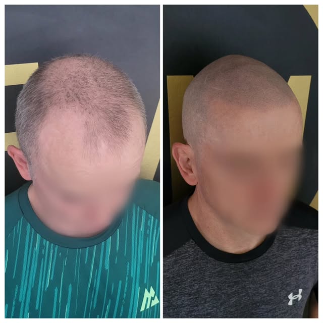 Hairline restored, and years knocked off with SMP 👌

Complimentary consultations available (in-clin