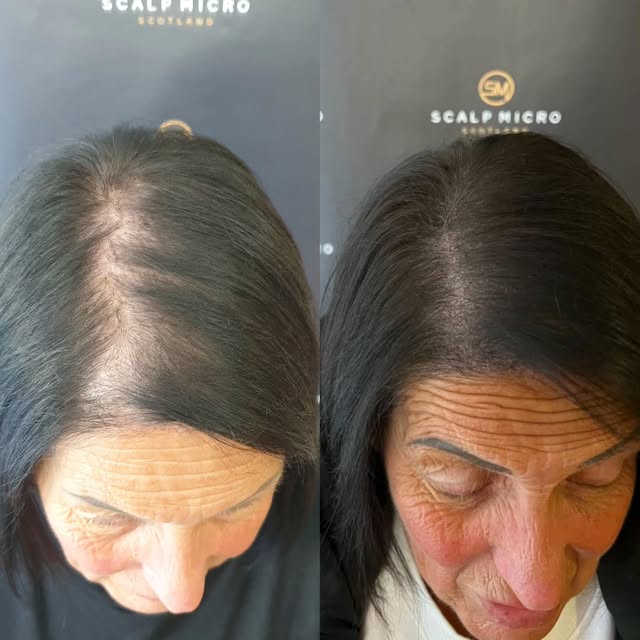 SMP for Women - A subtle change that can make a huge difference to how you feel about your hair 🙌

