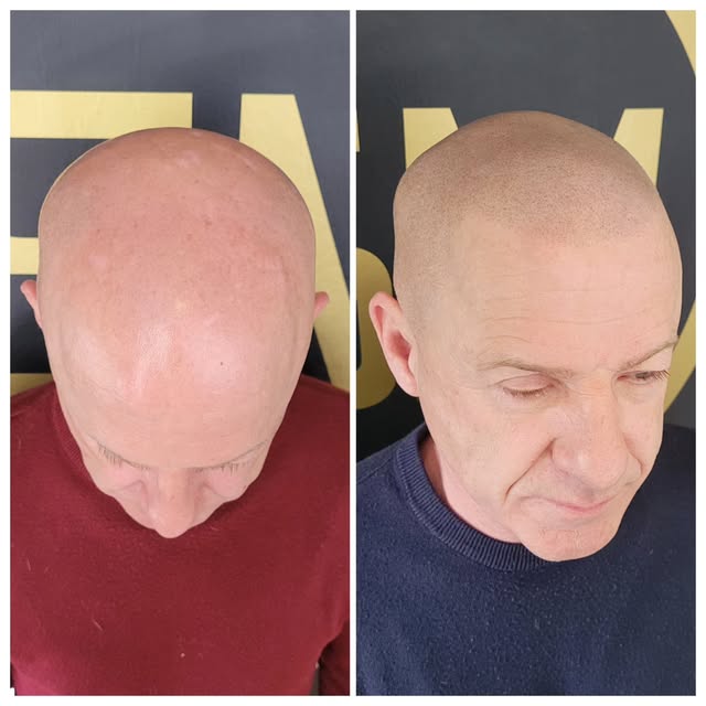 Hairline restored 👌

Complimentary consultations available (in-clinic or online)

📩 scalpmicroscot