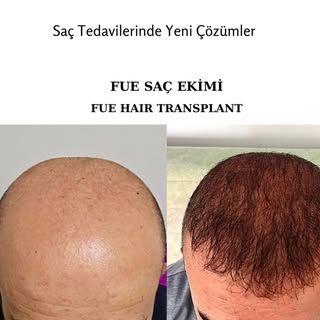 İleri evre kellikte donör alan yetersiz olduğunda ilave destek olarak çoğu zaman sakaldan aldığımız 