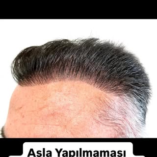Hatalı ön saç çizgisi…
unutmayın saç ekimi tıbbi bir işlemdir doktor kontrolünde değil  bizzat dokto