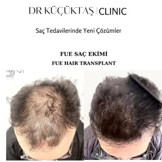 Dikkat saç çıkabilir :)