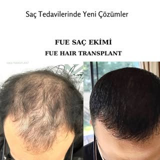 Genç hastalarda minyatürize olmuş saçlar yani incelmiş saç kökleri çok fazla ise bu kişilerde saç ek