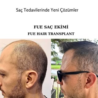 Geniş alan açıklığı olanlarda ideal sonuca ulaşmak briden fazla seans gerektirir. Önemli olan donör 