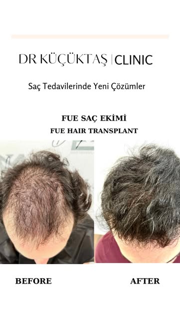 Saç Ekimi, FUE, 12. Ay
Hair Tranplant, FUE, 12thmonths
