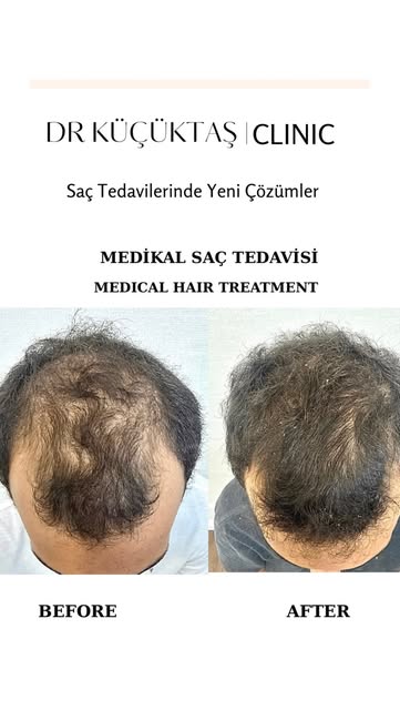 Medikal Saç Tedavisi
Medical Hair Treatment 

Genç yaş hastalarda incelmiş saçlar tıbbi tedavi ile t