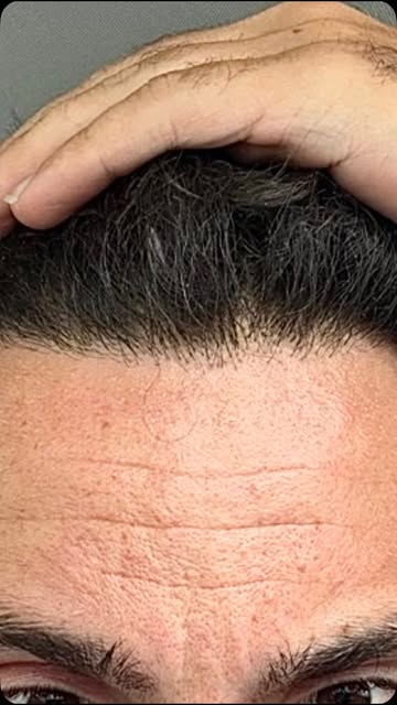 Doğal Ön Saç Çizgisi
Natural Front Hair Line